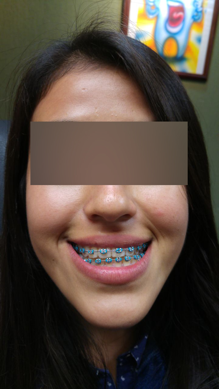 Caso 1 despues