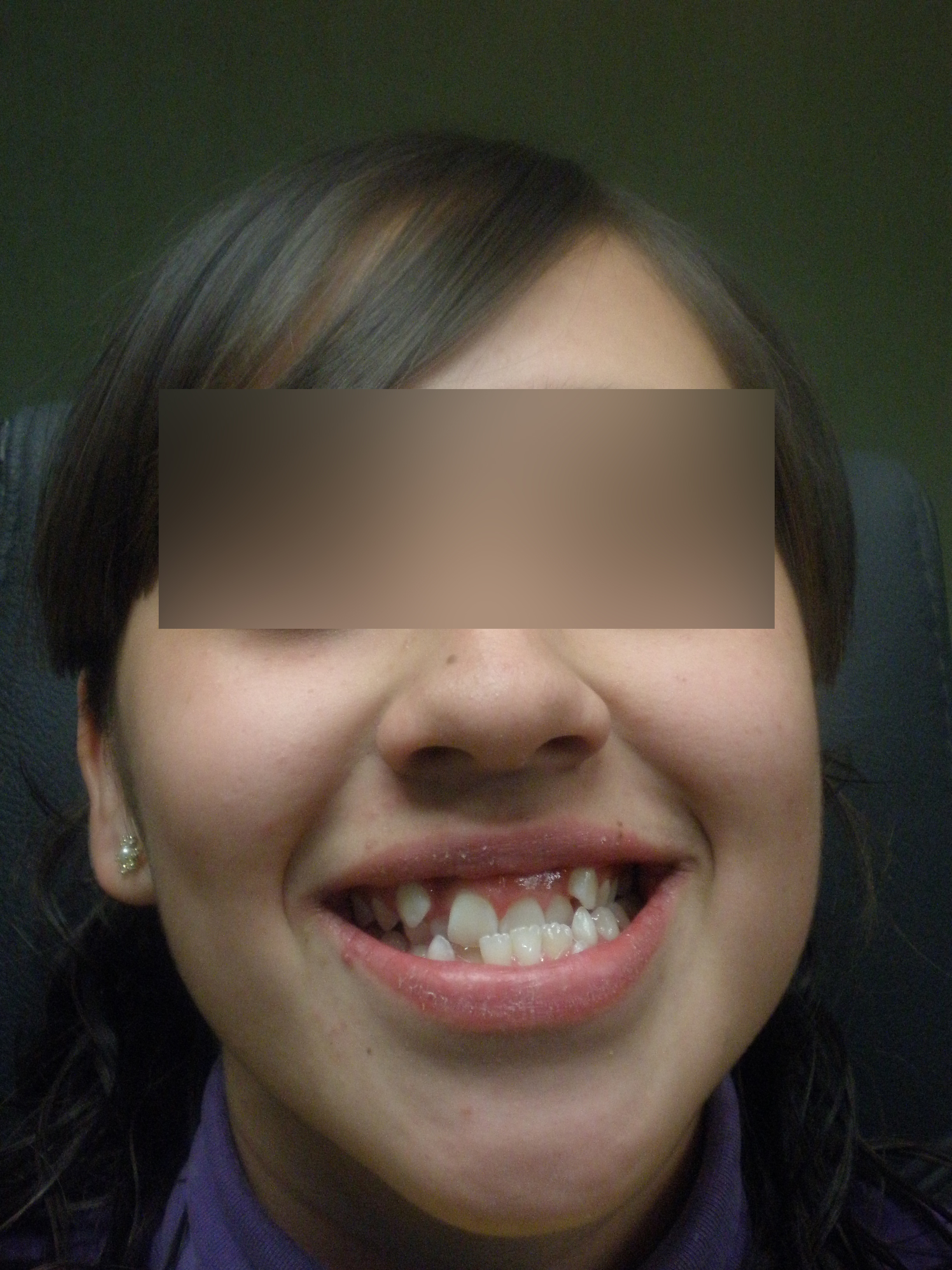 Caso 4 antes