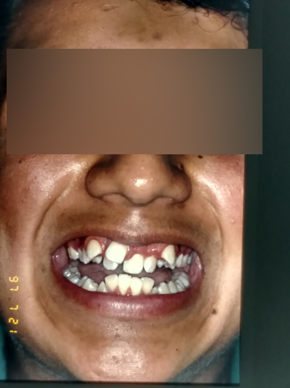 Caso 3 antes